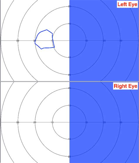 Figure 1 from Assessment of visual impairment in stroke survivors ...