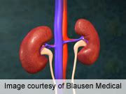 Three Serum Proteins Accurately Detect Kidney Cancer - Cancer Therapy Advisor