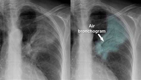 Air Bronchogram Chest X Ray