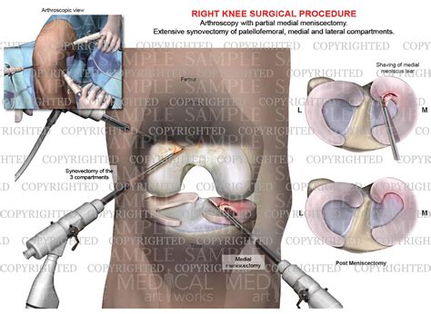 Arthroscopy of right knee with partial medial meniscectomy - tricompar – Medical Art Works