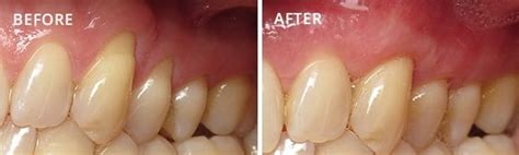 What Is the Pinhole Surgical Technique? | Tina Beck-Mayo, DDS