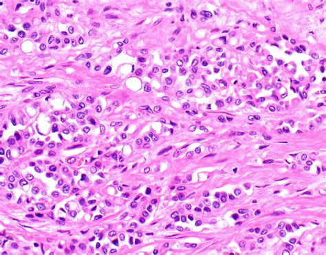 Epithelioid Mesothelioma Pathology Outlines - Goimages 411