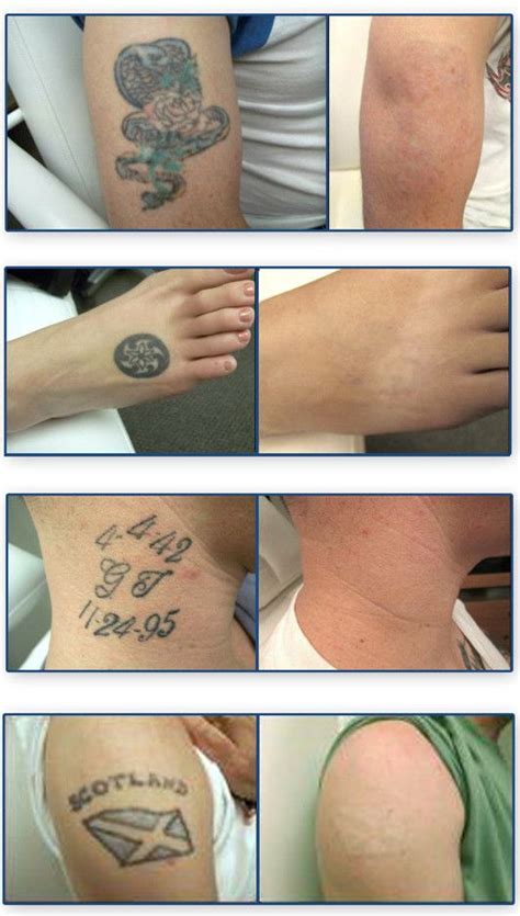 Tattoo Removal Before and After | Tattoo removal, Laser tattoo, Laser ...