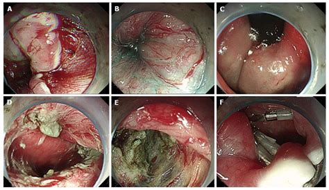 Combination of concurrent endoscopic submucosal dissection and modified peroral endoscopic ...