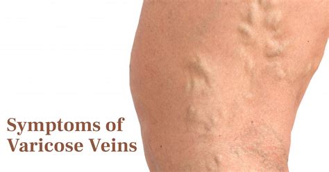 symptoms of varicose veins