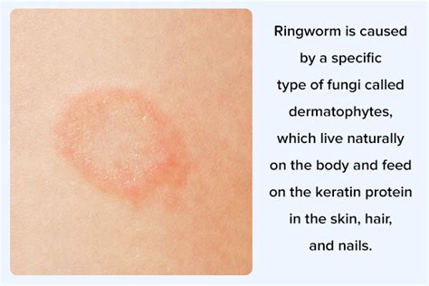 Ringworm In Children