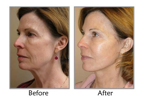 SLC Ut; Thompson Facial Plastics Explains The MACS Facelift Difference