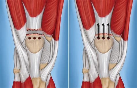 Pin on Quadriceps tendon