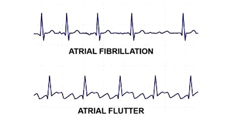 Atrial Fibrillation and Flutter - IRAN Health Tourism Organizer - Iran Medical Tourism - IRHTO