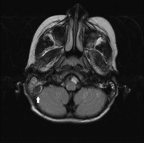 Sigmoid Sinus Thrombosis as a Complication of Acute Otitis Media in a 6 ...