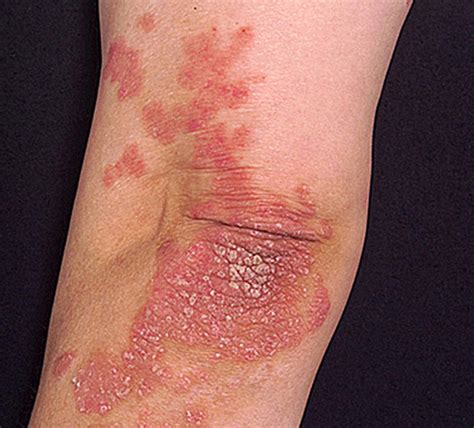 Psoriasis - Appearance, Causes, Types, Symptoms, Treatment, and Diet