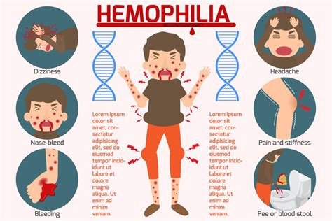 Hemophilia B : Overview, Causes, Symptoms, Treatment - illness.com