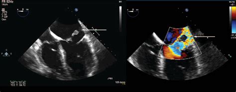 Echo rounds: three-dimensional transesophageal echocardiography of papillary muscle rupture ...