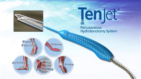 Percurtaneous Tenotomy (TenJet) - Susquehanna Orthopaedic Associates