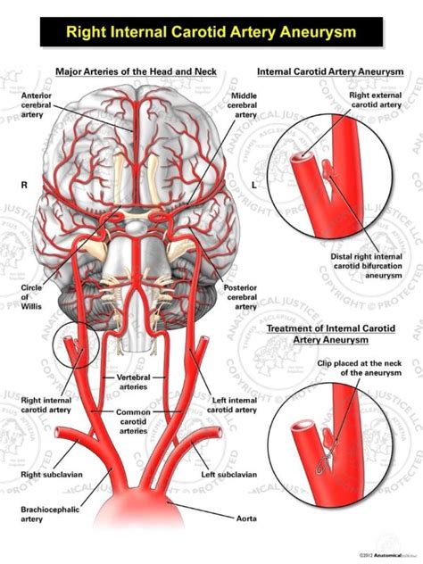 Right Internal Carotid Artery Aneurysm Illustration | Anatomical Justice