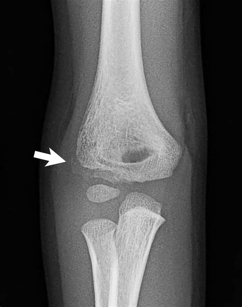 Elbow Grease Lateral And Medial Condyle Fractures Of The Humerus | My ...