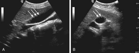 Focal Gallbladder Wall Thickening | Radiology Key