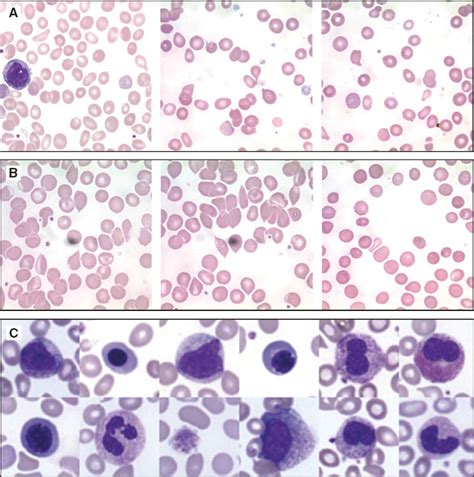 Significance of teardrop cells in peripheral blood smears