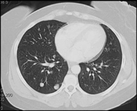 Lung Hamartoma - Chest Case Studies - CTisus CT Scanning