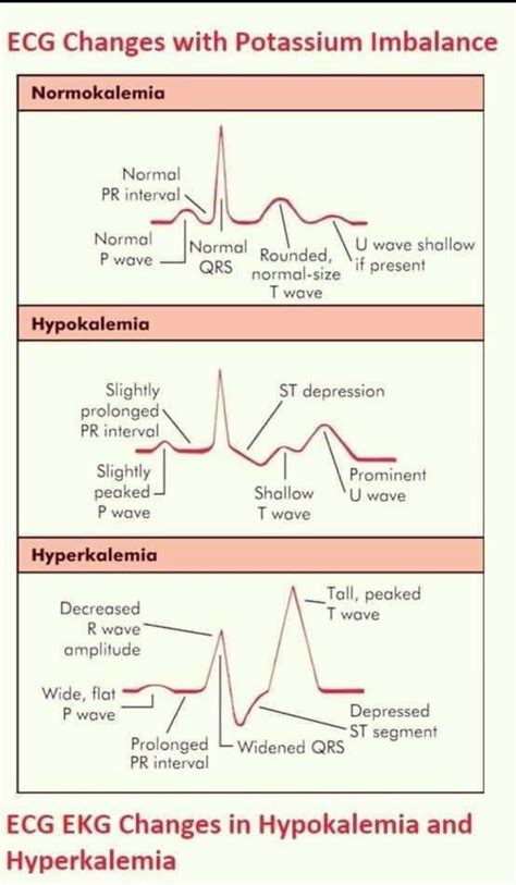 Sine Wave Hyperkalemia Ecg Changes