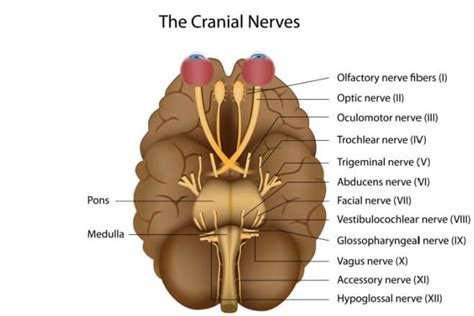 MRI Confirmed Bell's Palsy Presenting With Multiple Cranial, 47% OFF