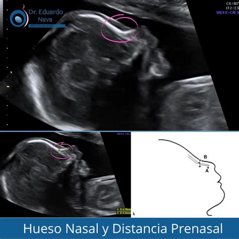 La medición del hueso nasal en conjunto con la medición de la distancia ...