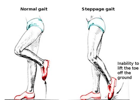 Steppage Gait - Cause, Symptom, Treatment, Exercise - Samarpan