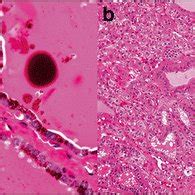 Histologic sections of the thyroid gland showed extensive dark brown... | Download Scientific ...