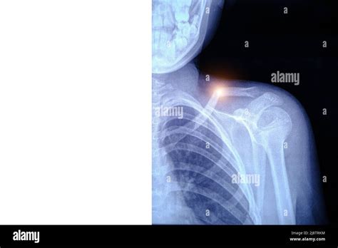 X-ray image broken collarbone person Stock Photo - Alamy