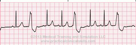 Premature Ventricular Contractions (PVC) - Boss RN