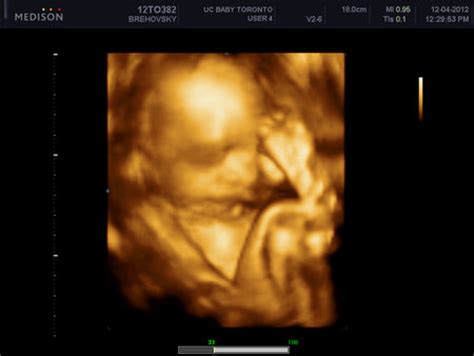 3D Ultrasound/Baby is Breech! | BabyCenter