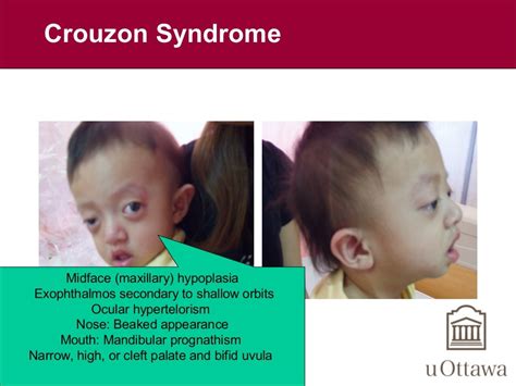 Craniofacial anomalies