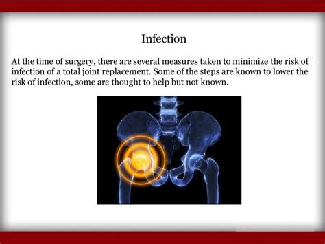 Symptoms of Hip Replacement Implant Recall