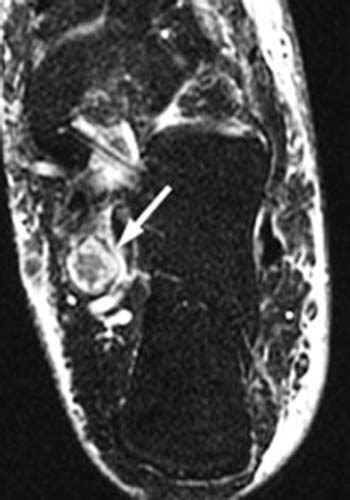 Tarsal Tunnel Syndrome - Radsource