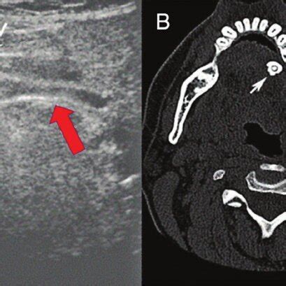 A) Display of stone and dilatation of the Wharton`s duct; B) CT axial ...