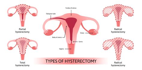 Open Hysterectomy - Understanding What It Means