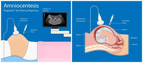 Amniocentesis: All You Want to Know