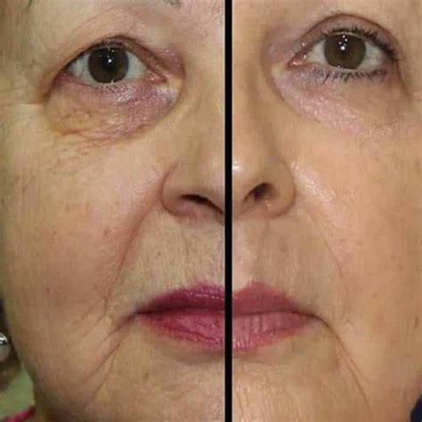 Dramatically improve Slack skin. High success rate NO SURGERY