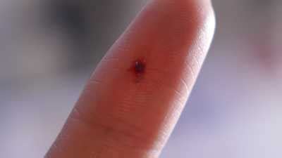 Blood clot in finger: 5 Causes, Symptoms, 10 Home Remedies