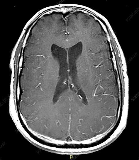 Extensive Dural Sinus Thrombosis, MRI - Stock Image - C036/5128 ...