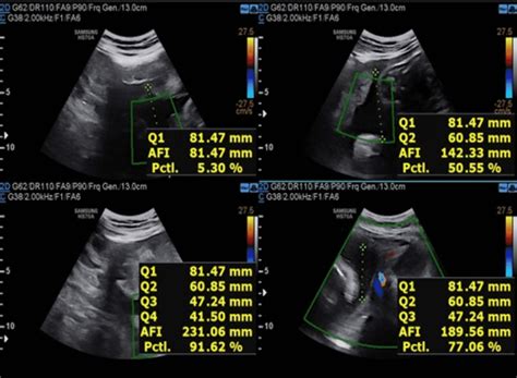 Cureus | Association and Correlation Between Amniotic Fluid Index and ...