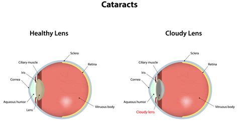 Cataract Prevention - Discovery Eye Foundation