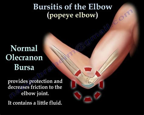 Bursitis Elbow / Olecranon Popeye Elbow - Everything You Need To Know - Dr. Nabil Ebraheim - YouTube