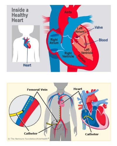 Cardiac Catheterization in a Child | Norton Children's Louisville, Ky.