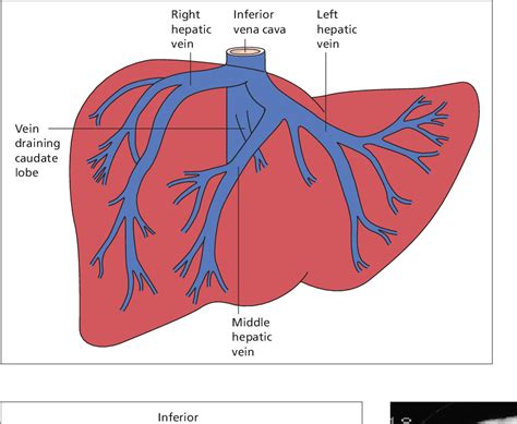 Figure 9.63 from The Hepatic Artery, Portal Venous System and Portal ...