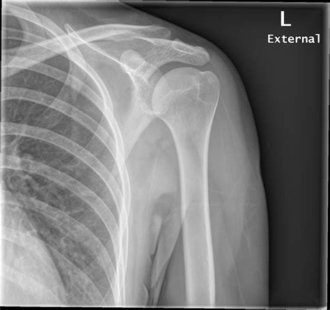 Normal Shoulder Joint X Ray