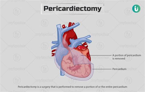 Pericardiectomy: Procedure, Purpose, Results, Cost, Price