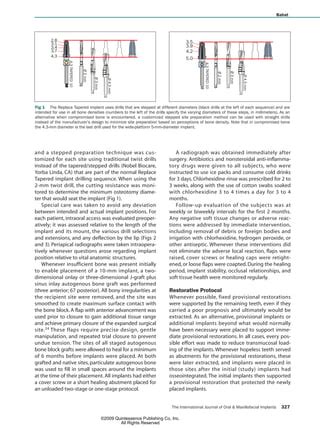 Technique for Placement of Oxidized Titanium Implants by Oded Bahat | PDF