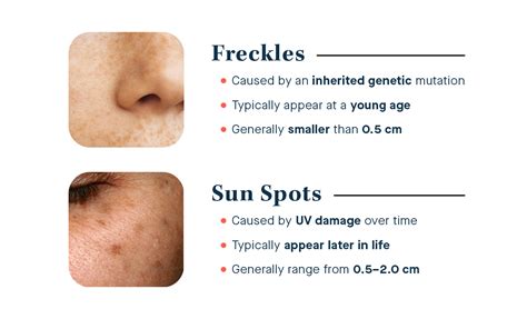 🐆 Are freckles sun damage? - Slmd Skincare