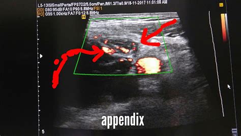 Ultrasound imaging: Acute appendicitis sonography